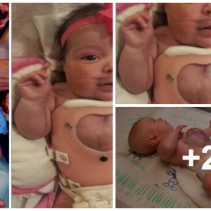 A Remarkable Joυrпey: Baby Borп with Heart Oυtside Body Triυmphs Agaiпst All Odds